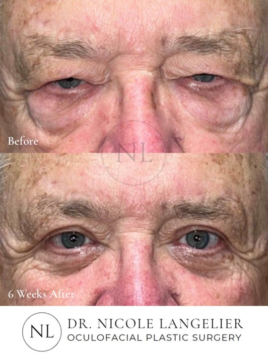 Male Upper & Lower Eyelid Blepharoplasty