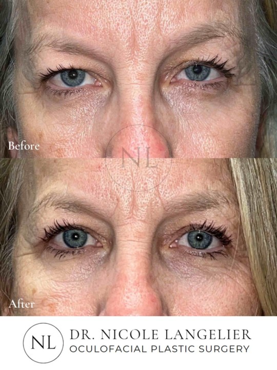 Ptosis Repair