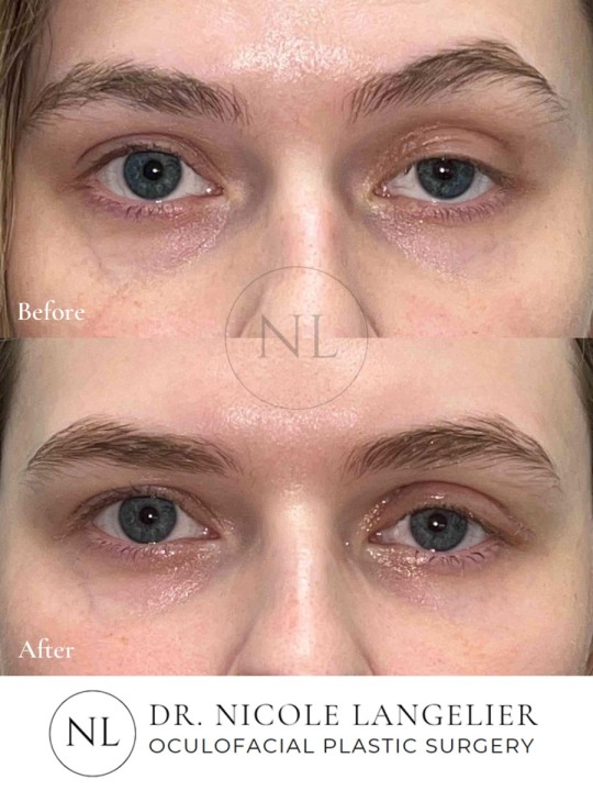 Ptosis Repair