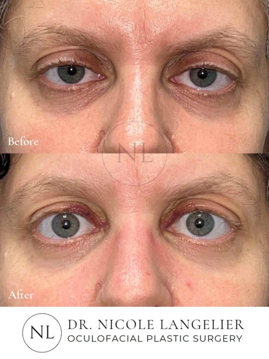 Ptosis Repair
