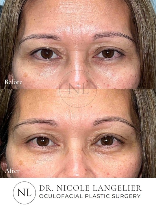 Left Upper Eyelid Ptosis Repair