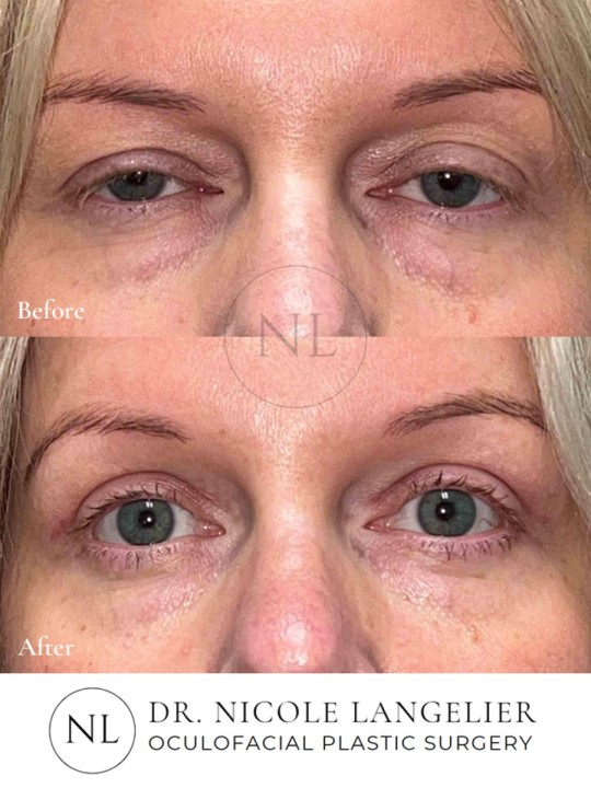 Ptosis Repair