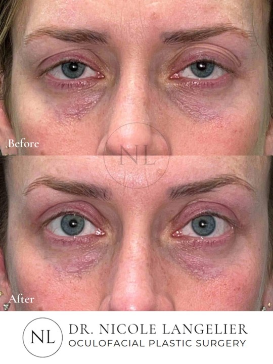 Ptosis Repair