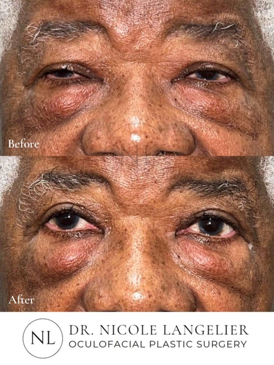 Ptosis Repair