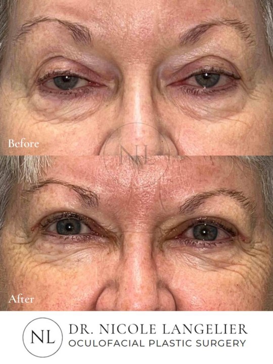 Ptosis Repair