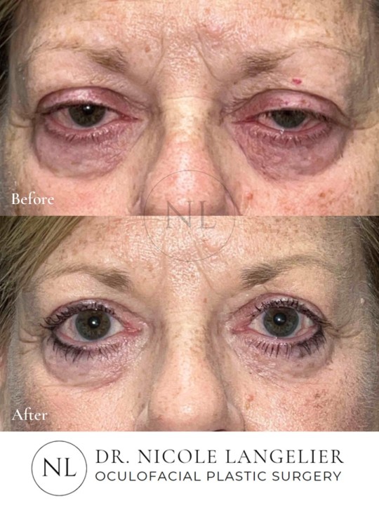 Ptosis Repair