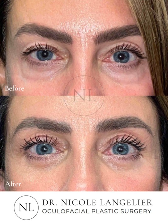 Ptosis Repair