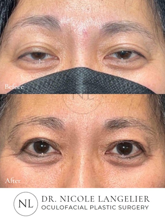 Ptosis Repair