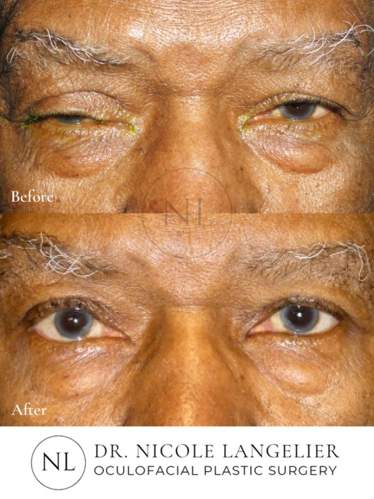 Ptosis Repair