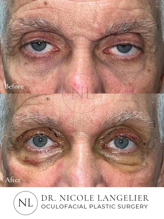 Ptosis Repair
