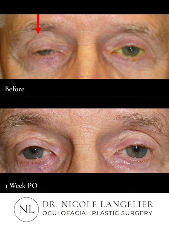 Right Upper Eyelid Ptosis Repair
