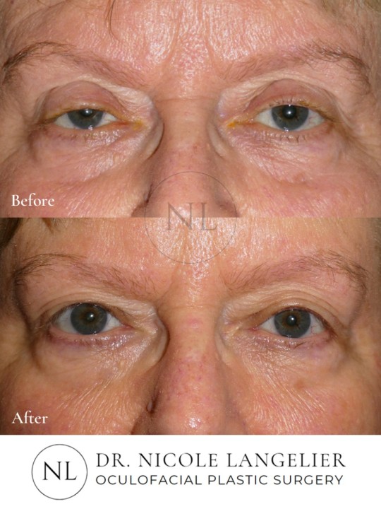 Ptosis Repair