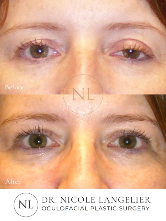 Ptosis Repair