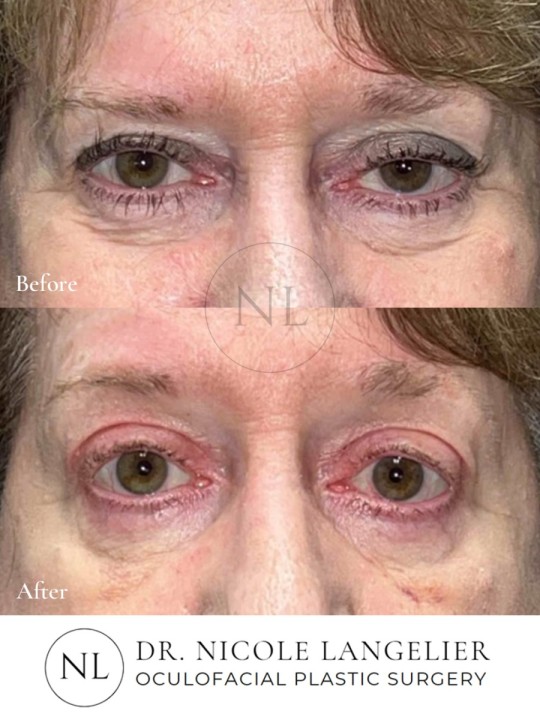 Ptosis Repair