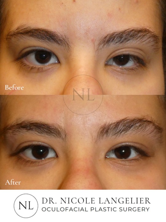Ptosis Repair