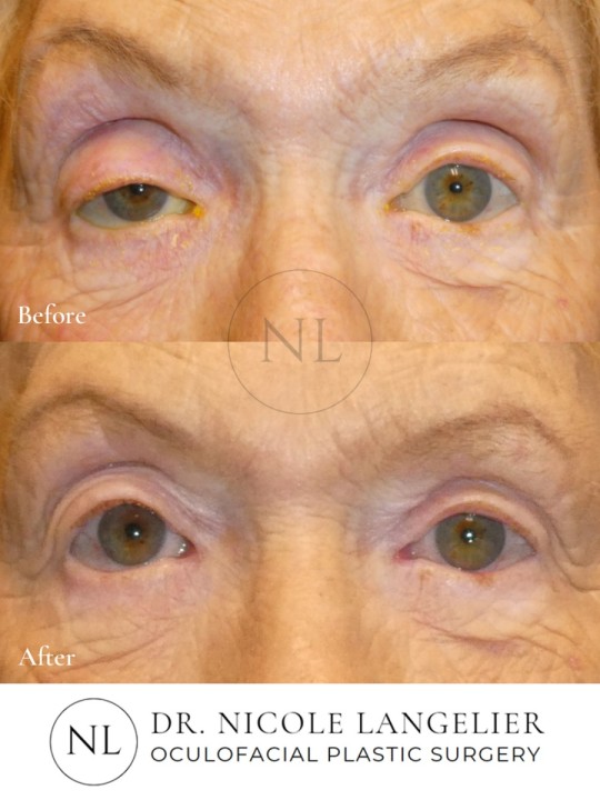 Ptosis Repair