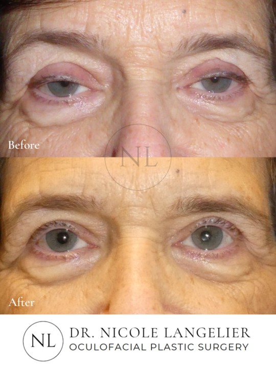 Ptosis Repair