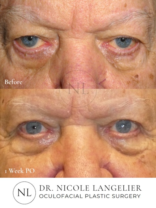 Ptosis Repair