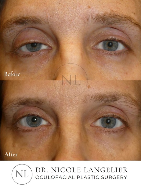 Ptosis Repair