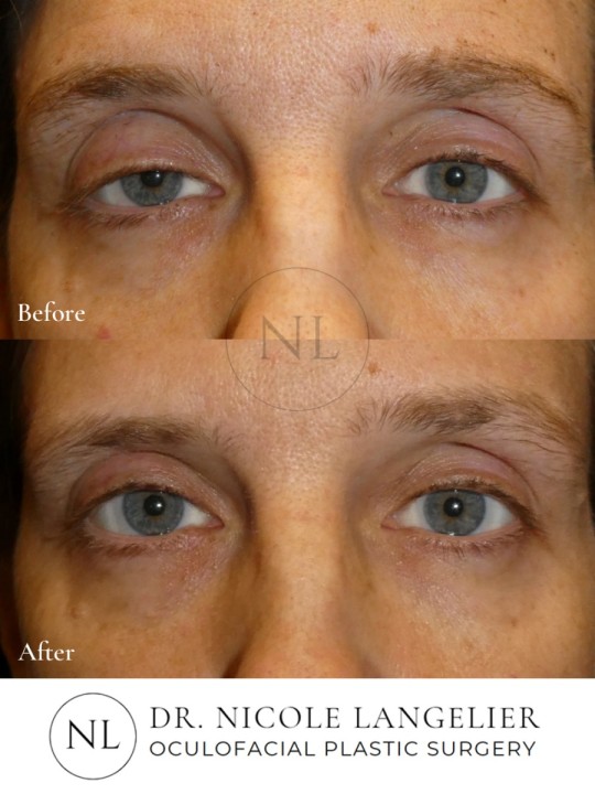 Ptosis Repair