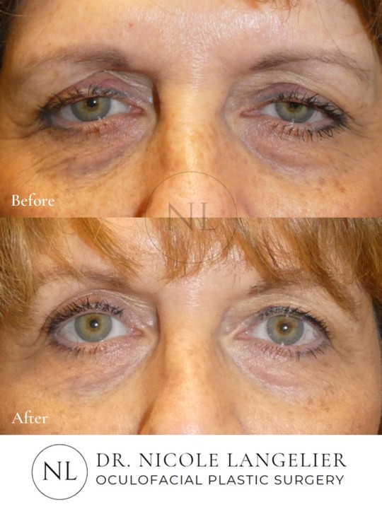 Ptosis Repair