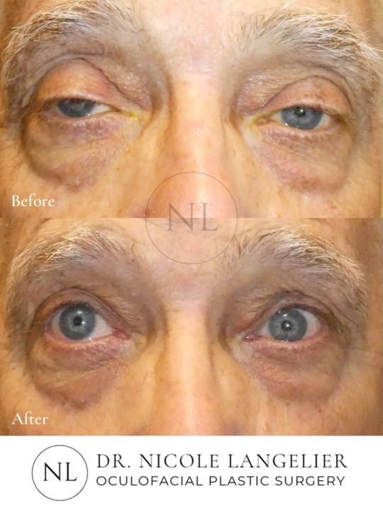 Ptosis Repair