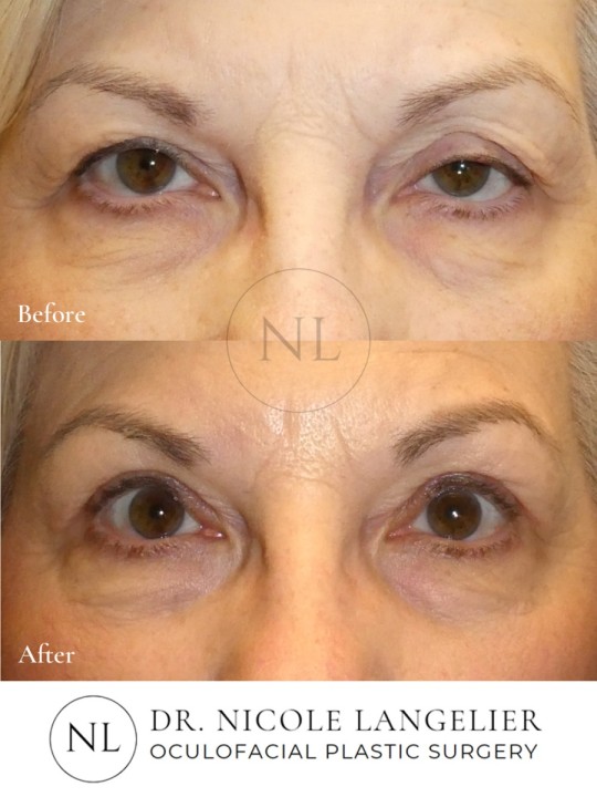 Ptosis Repair