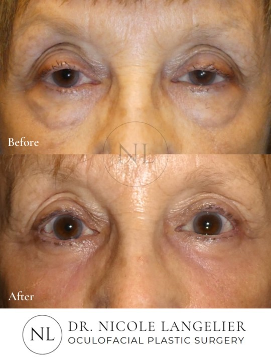 Ptosis Repair