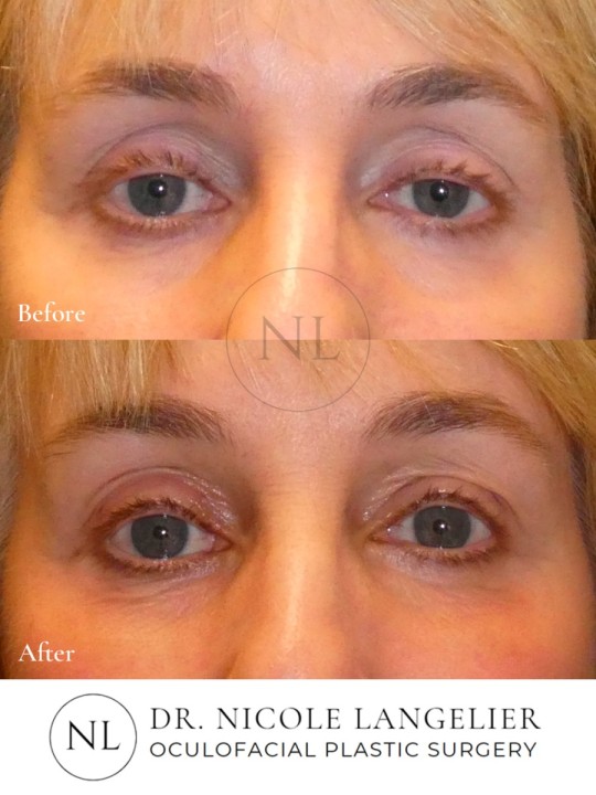 Ptosis Repair