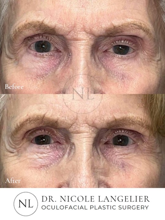 Ptosis Repair