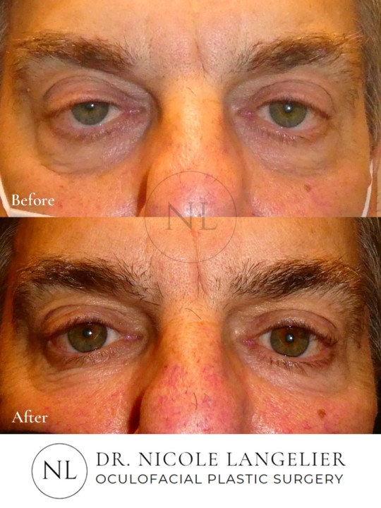 Ptosis Repair