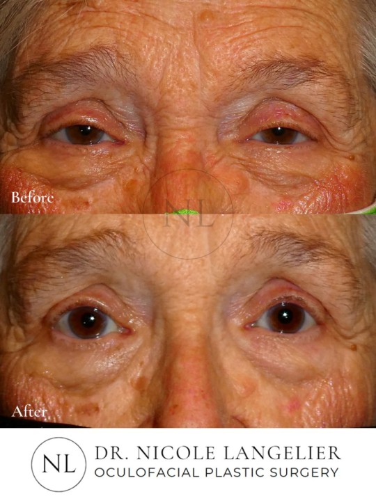 Ptosis Repair
