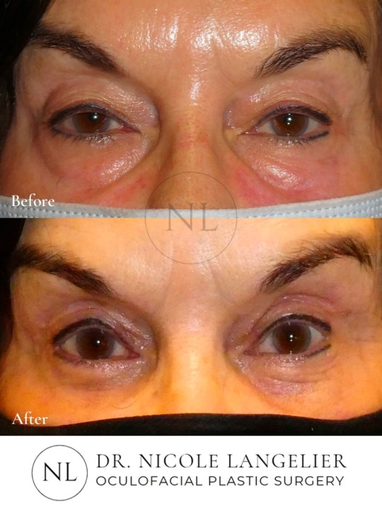 Ptosis Repair