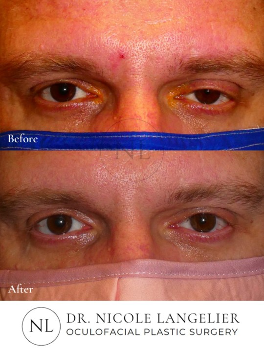 Ptosis Repair