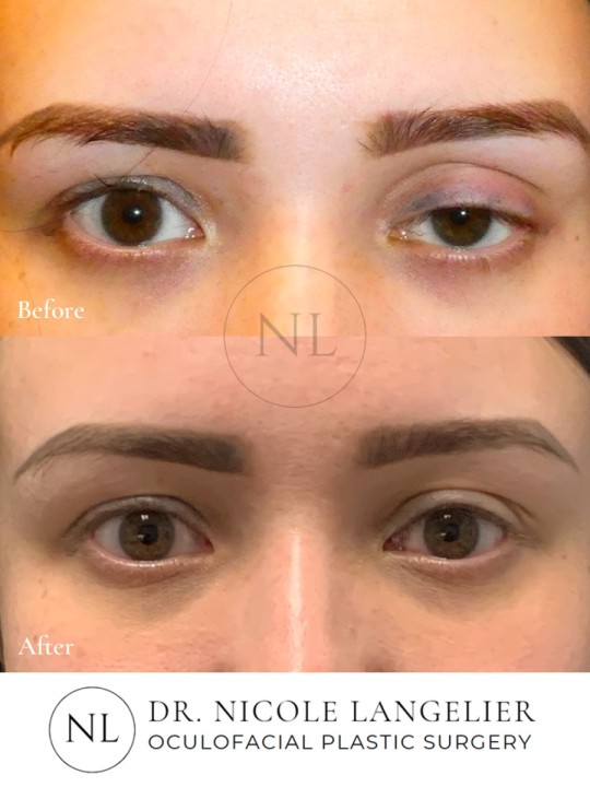 Ptosis Repair