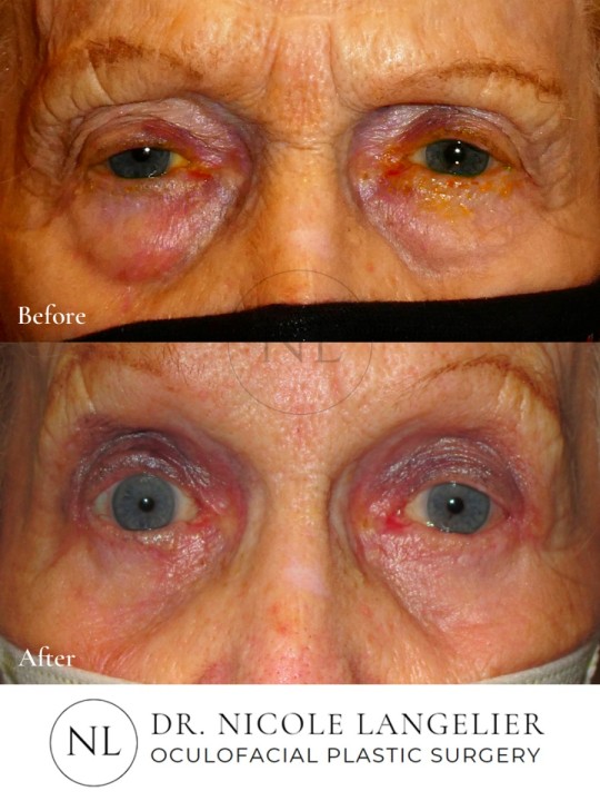 Right Upper Eyelid Ptosis Repair