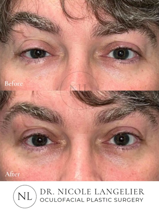 Ptosis Repair