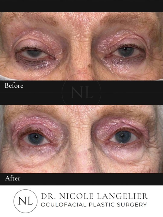 Upper Eyelid Ptosis Repair
