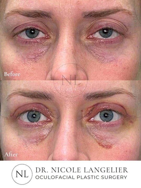 Upper and Ptosis Before and After