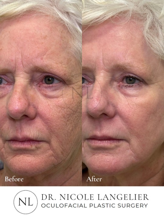 Sciton Contour TRL Laser Resurfacing