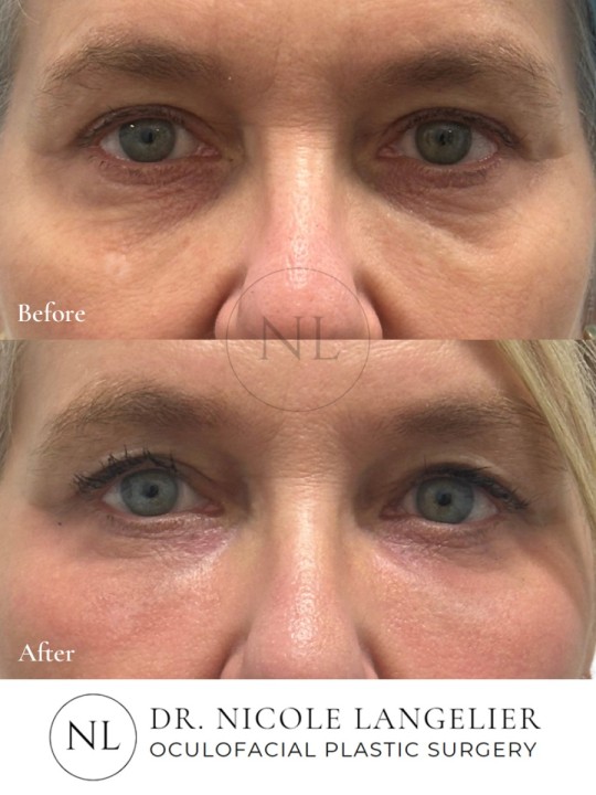 Sciton Contour TRL Laser Resurfacing