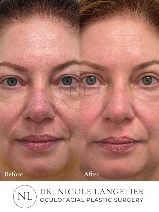 Sciton Contour TRL Laser Resurfacing