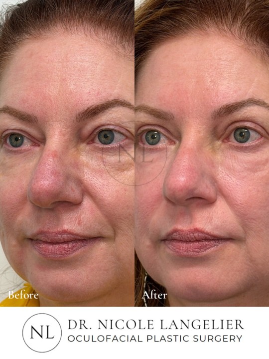 Sciton Contour TRL Laser Resurfacing