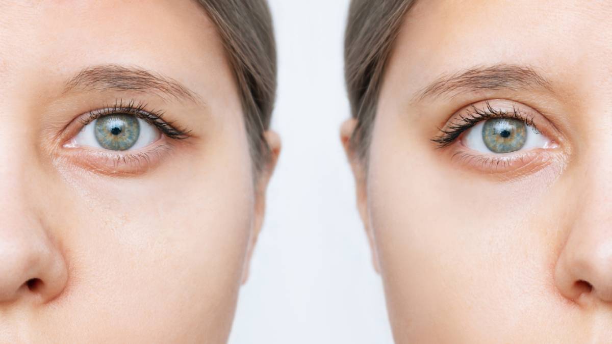 Featured image for How Can You Get Insurance to Pay for Eyelid Surgery?​