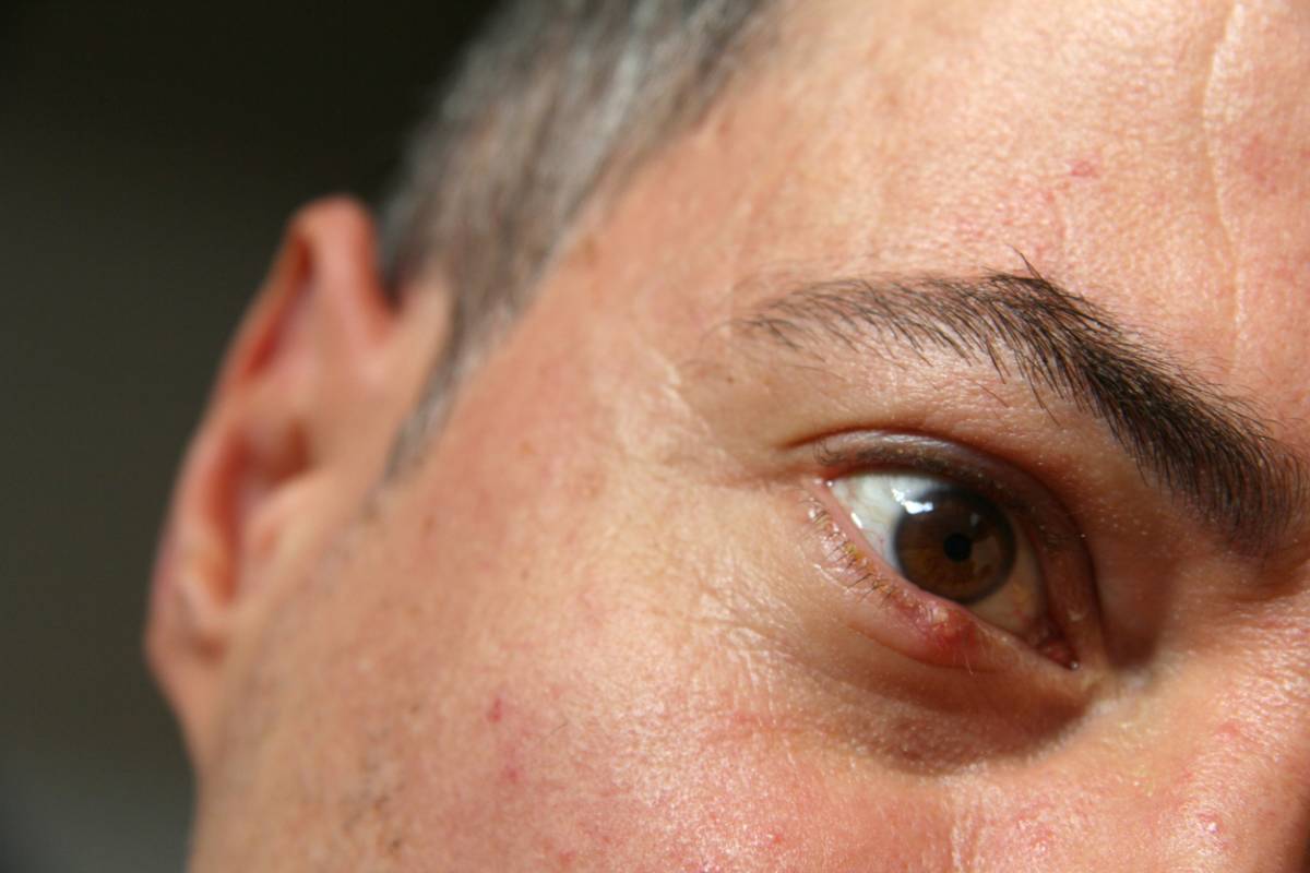 Featured image for Why Do Eyelid Bumps Form?
