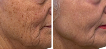 Treatment of TRL Erbium Laser Resurfacing Patient of Dr. Langelier & Nurse Leisha