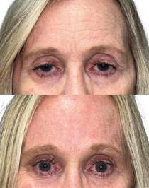 brow-lift-patient