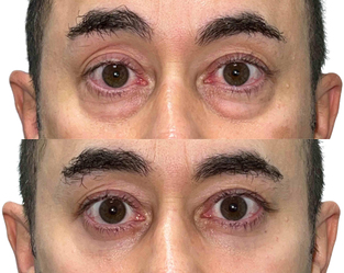 lower-blepharoplasty-patient