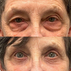 upper-and-lower-blepharoplast-patient