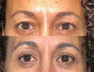 upper-blepharoplasty-patient